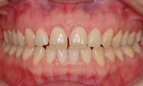 레진 비니어 등의 레진 치료를 이용한 앞니 형태 개선 (왜소치, diastema, black triangle) @ 대치동 연세정원치과 관련 이미지 3