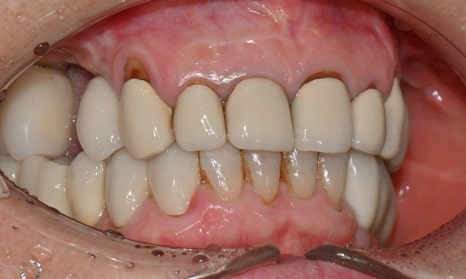 심미와 기능을 모두 고려한 앞니 심미보철 재치료 관련 이미지 4