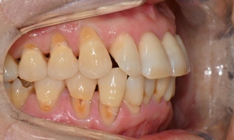 대치동 치경부 레진 & 중년교정 & 치아미백으로 자연스러운 미소를! 관련 이미지 3