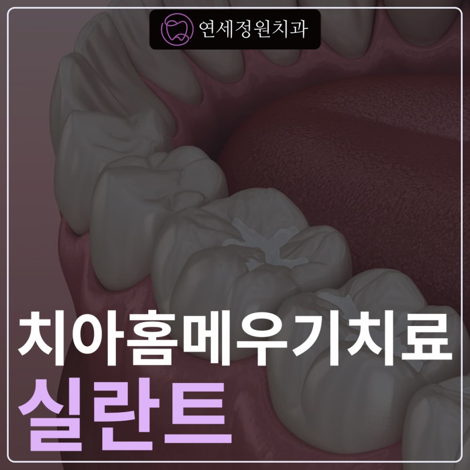 영구치에 실란트를 하면 충치가 안 생기나요? @ 대치동소아치과 연세정원치과 관련 이미지 1