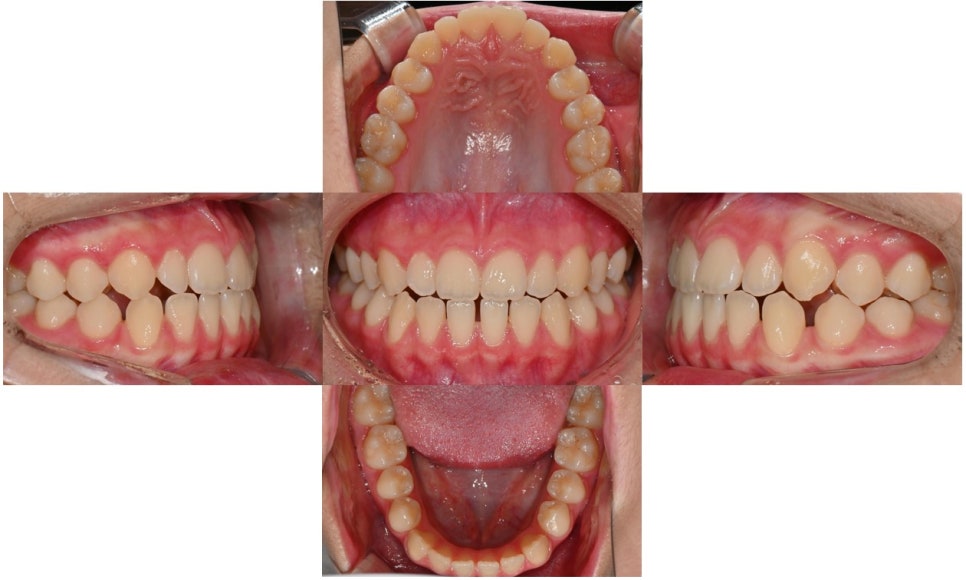 어린이 주걱턱, 페이스 마스크 성장교정 후 인비절라인 관련 이미지 5