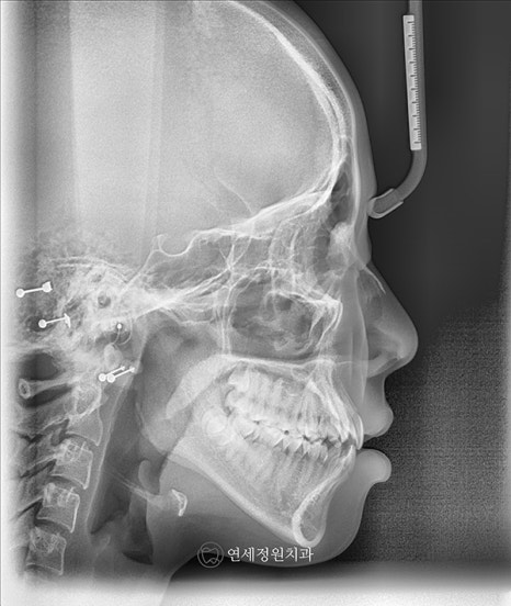 유학생 치아교정, 인비절라인 연세정원치과 관련 이미지 11
