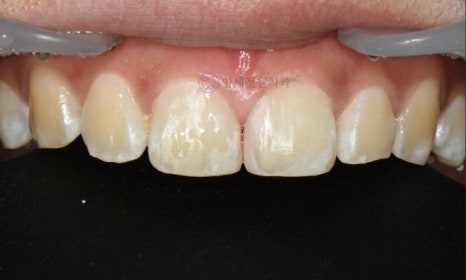 앞니 심미 레진 치료 : 블랙트라이앵글, 앞니 사이 공간 @ 대치동 연세정원치과 관련 이미지 6