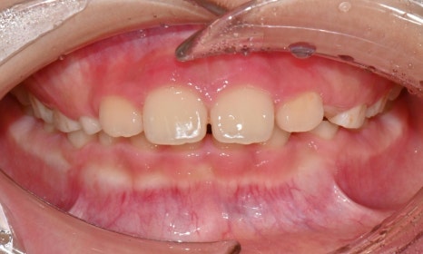 Why Is a Second Phase of Orthodontic Treatment Needed After the First? – A Case of Invisalign Treatment for a Growing Patient with Anterior Crossbite image 4
