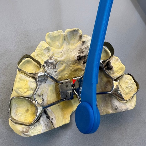 악궁확장장치(RPE, MARPE, MSE) 돌리는 방법 관련 이미지 11