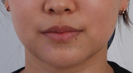 치아 중심선이 안 맞아요! 치아 비대칭 교정으로 가능할까요? @ 대치동 교정치과 연세정원치과 관련 이미지 14