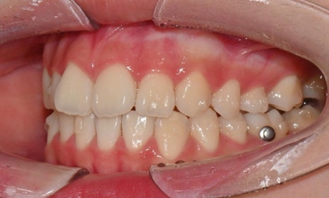 고등학생 인비절라인 교정｜앞니 치아배열 &middot; 과개교합 관련 이미지 14