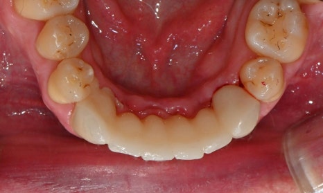 과개교합과 손상된 앞니, 심미와 기능을 함께 회복한 앞니 심미보철 케이스 관련 이미지 12