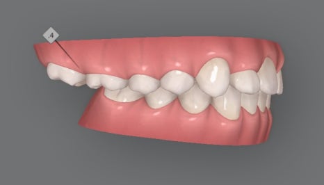 성장기 무턱교정 인비절라인 MA(mandibular advancment) 관련 이미지 8