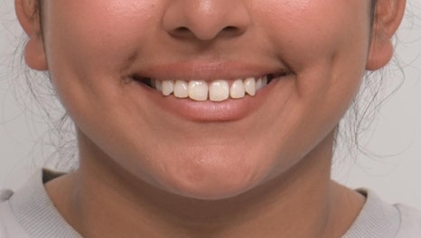 인비절라인 앞니 사이 공간 및 덧니 교정 관련 이미지 17