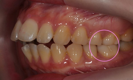 앞니가 안 물려요! 개방교합(openbite) 치아교정 전후 및 후기 관련 이미지 3