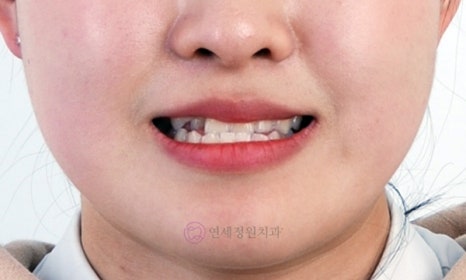 비수술 주걱턱 교정, 대치동 교정치과 연세정원치과 관련 이미지 4