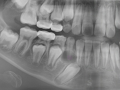 어린이 치아교정 해야 될까요? 대치동 교정치과 관련 이미지 5