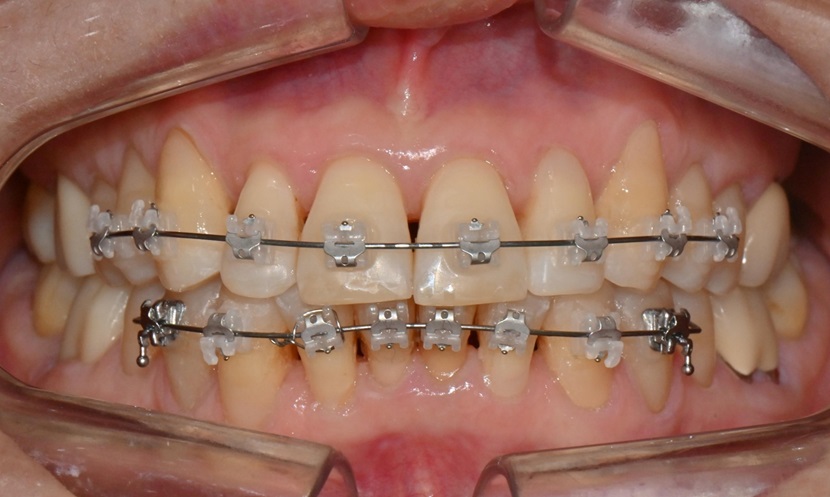 대치동 치경부 레진 & 중년교정 & 치아미백으로 자연스러운 미소를! 관련 이미지 11