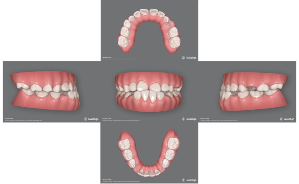 Why Is a Second Phase of Orthodontic Treatment Needed After the First? – A Case of Invisalign Treatment for a Growing Patient with Anterior Crossbite image 2