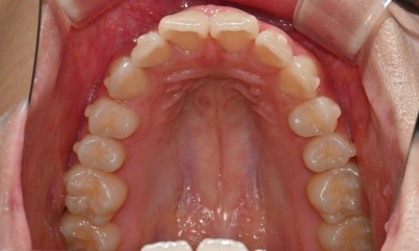 고등학생 인비절라인 교정｜앞니 치아배열 &middot; 과개교합 관련 이미지 15