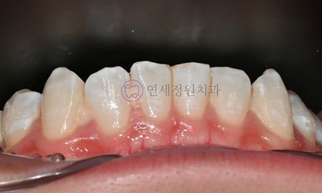 치아 미백 후 반점치의 아이콘 레진 치료 @ 대치동 연세정원치과 관련 이미지 4