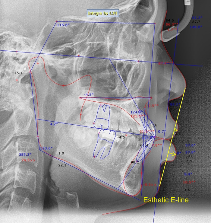 발치교정과 비발치교정, 나에게 맞는 방법은? 관련 이미지 2