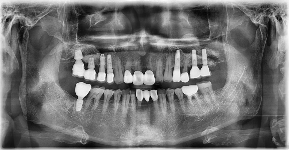 임플란트와 고혈압, 당뇨, 골다공증 등의 전신질환 관련 이미지 7