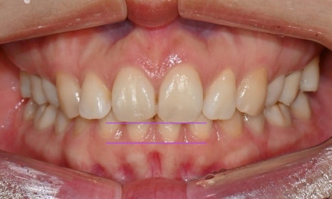 인비절라인 익스프레스 부분교정 <앞니 재교정> 관련 이미지 9