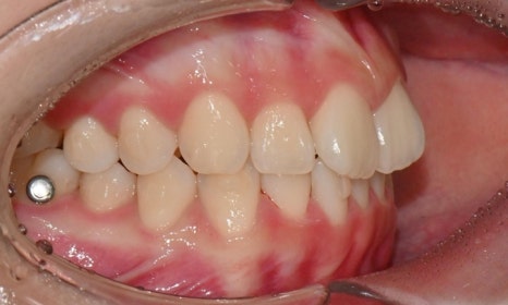 고등학생 인비절라인 교정｜앞니 치아배열 &middot; 과개교합 관련 이미지 8