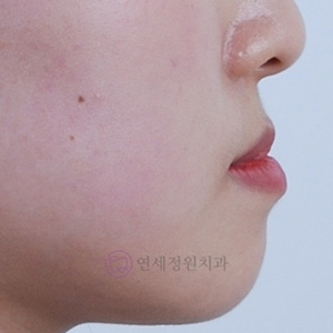 비수술 주걱턱 교정, 대치동 교정치과 연세정원치과 관련 이미지 8