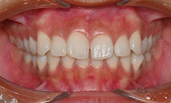 개포동 앞니 사이 공간 및 덧니 교정을 원한다면 관련 이미지 2