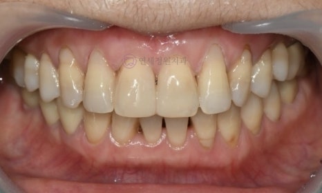 레진 비니어 등의 레진 치료를 이용한 앞니 형태 개선 (왜소치, diastema, black triangle) @ 대치동 연세정원치과 관련 이미지 10