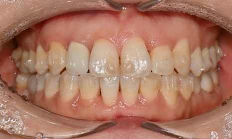 교정 치료 후 치아 미백 관련 이미지 4