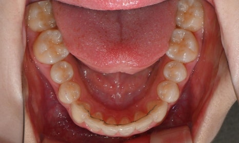 고등학생 인비절라인 교정｜앞니 치아배열 &middot; 과개교합 관련 이미지 21