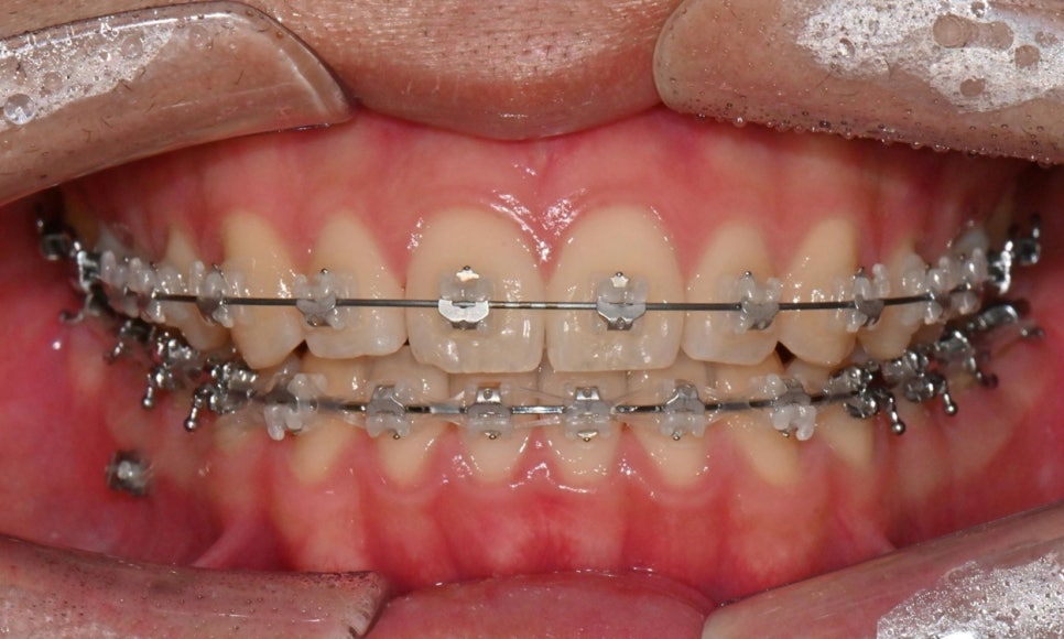 치아 중심선 비대칭과 아랫입술 돌출 개선 관련 이미지 13