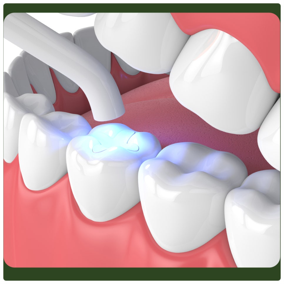 Eating After Resin Treatment: What Should You Be Careful About? image 2