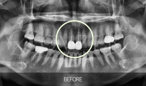 When Exactly Should Root Canal Treatment Be Done? image 2