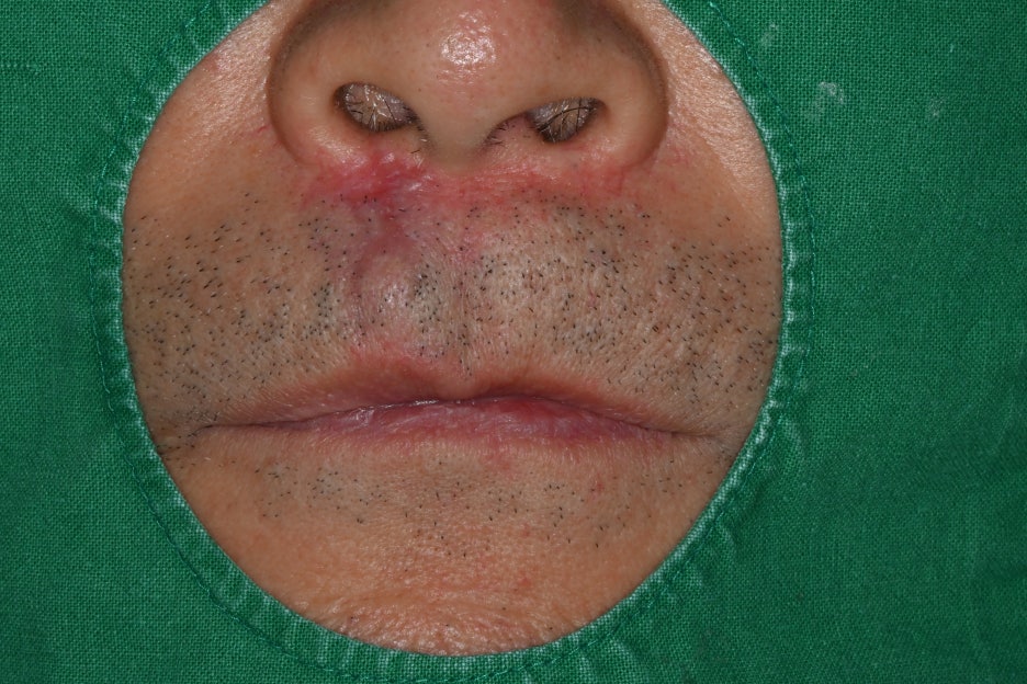 Songpa Dental Clinic: Man in His 70s Fell on Sidewalk Blocks, Requiring Laceration Suturing and Implant Surgery image 9