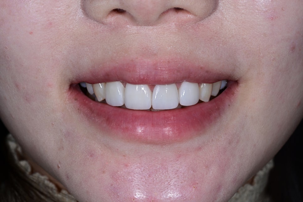 Rabbit Teeth Veneers: Treatment to Achieve Natural Front-Tooth Proportions image 7