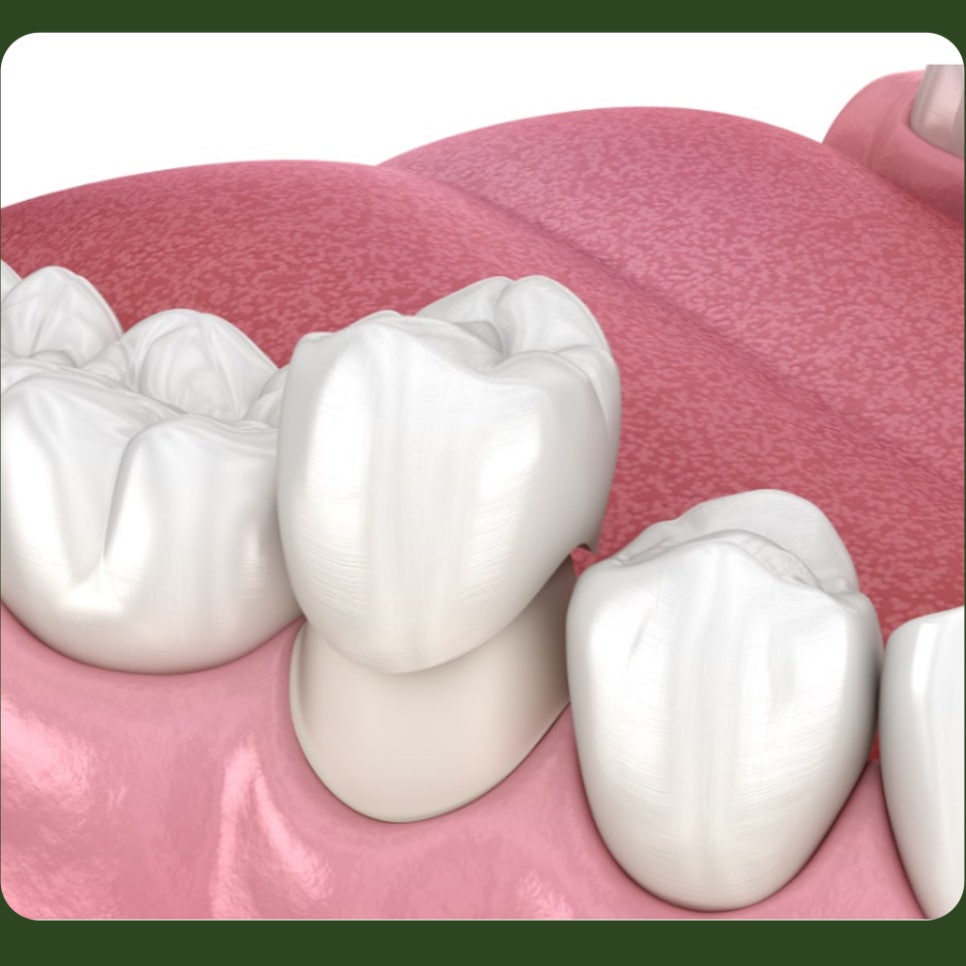 Crown loosening: if you can feel it and there’s a smell, what does it mean? image 3