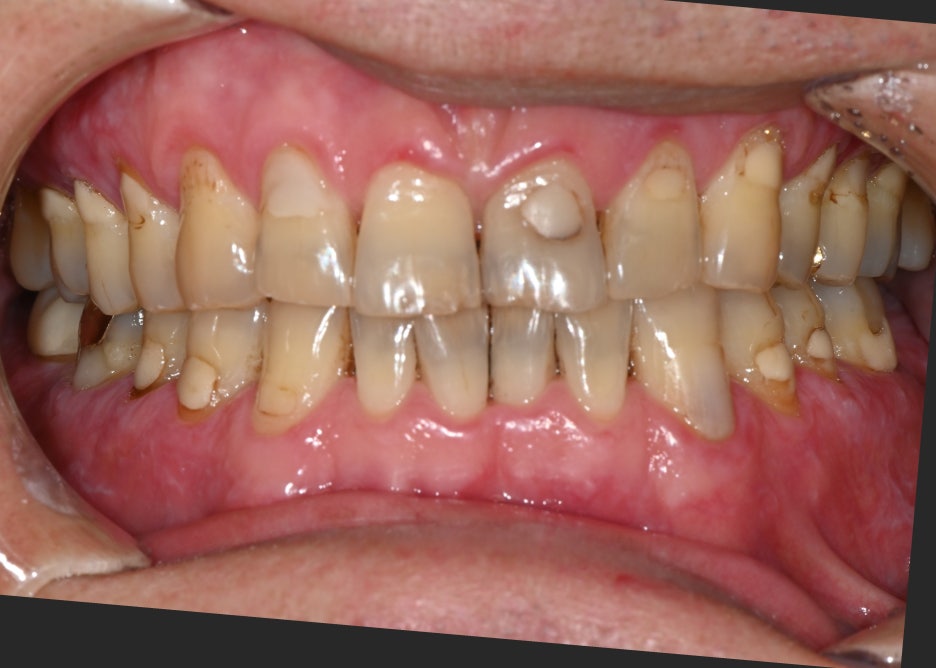 Jamsil Dental Hospital Implant Price and Treatment Case image 4