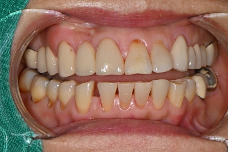Front Tooth Crown + Implant for an Overseas Patient: What Made It Possible to Finish in 4 Months? image 2