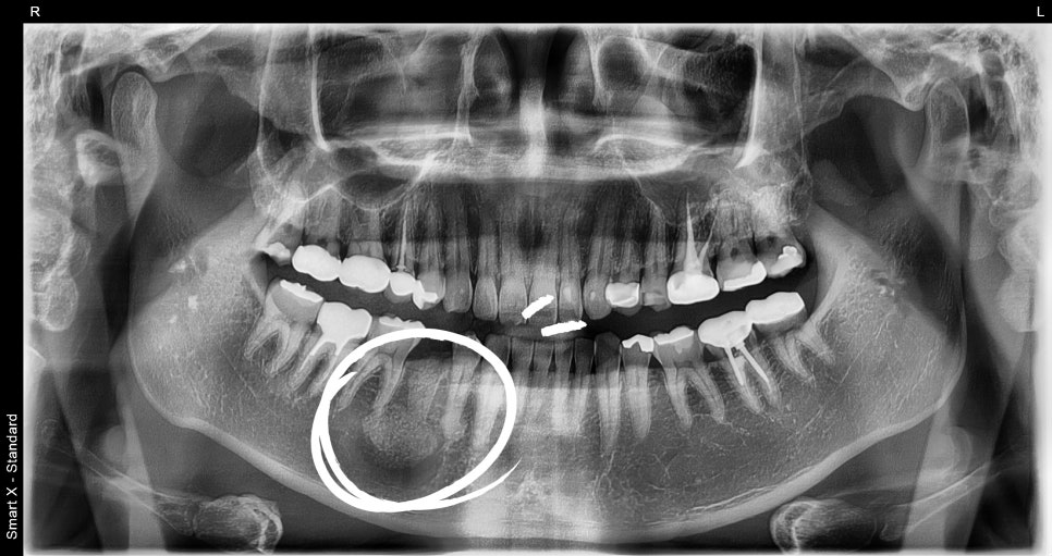 About Jawbone Benign Tumors and IV Sedation at Samjeon Station Dental Clinic image 6