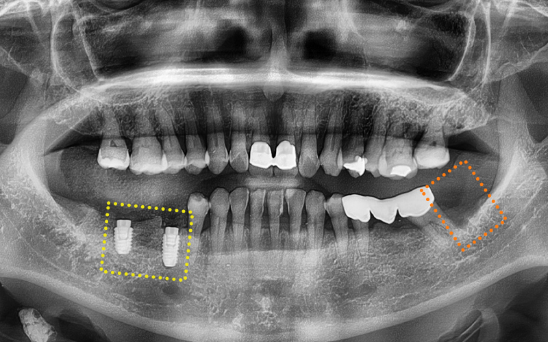 [Seokchon Gobun Station Dental Clinic] When Is an Implant Needed? image 4