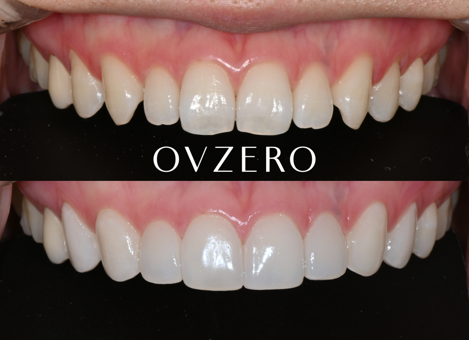 The OVZERO Laminate That Even Jamsil Dental Clinic Staff Trust and Receive! image 1