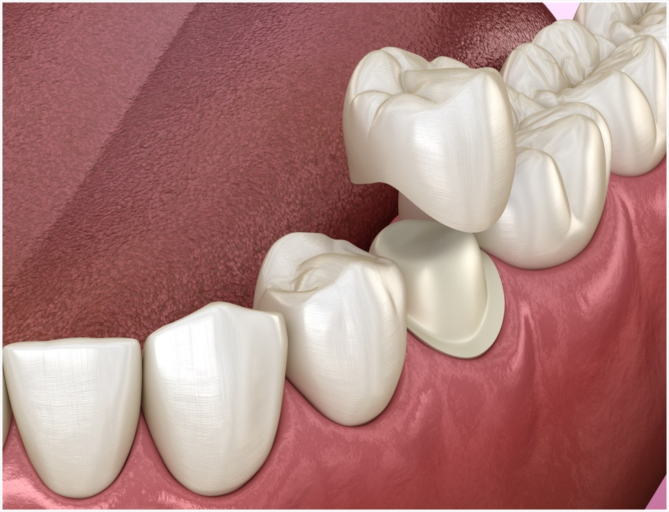 Why Is a Crown Placed After Root Canal Treatment? image 6