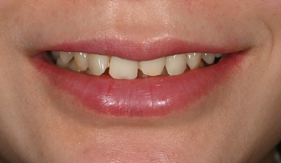 Tooth Wear: Resin? Veneers Are Also an Option image 2