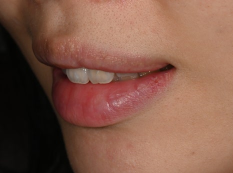 Jamsil Veneers: Worried About Rabbit Teeth? image 4