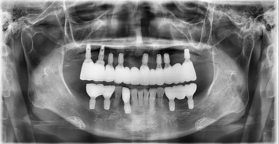 Full-Mouth Implant Price: Treatment Review of a Patient in Their 60s Who Restored Damaged Teeth image 12