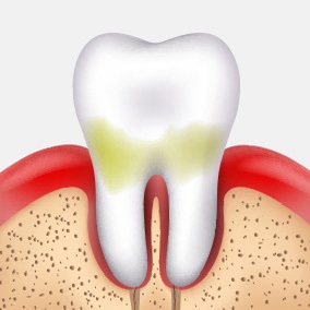 Half of Adults Are Leaving It Untreated?! Restore Healthy Teeth with Gum Treatment image 3