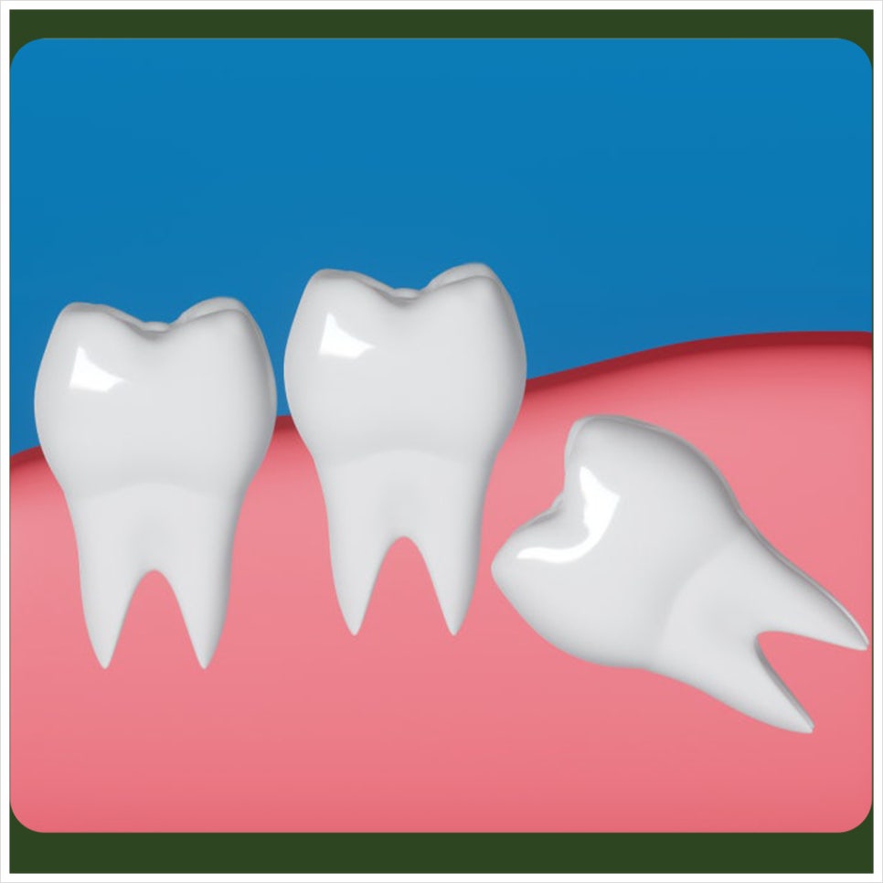 Why Should You Be Careful with Straws After Wisdom Tooth Extraction? image 3