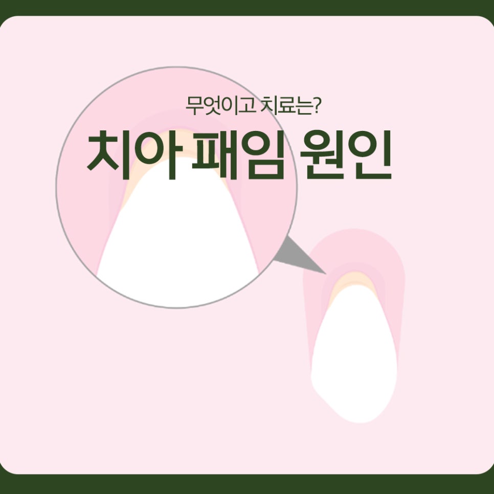 What Causes Tooth Notching, and How Is It Treated? image 1