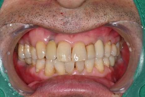 어금니 임플란트가격, 임플란트치과에서 진행한 실제 치료 과정 관련 이미지 5