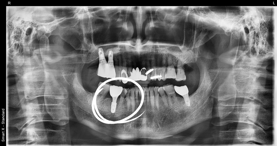 Understanding Implant Price Differences Through the Molar Implant Process image 11